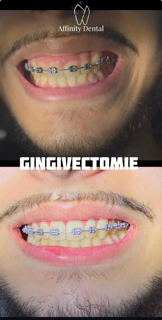 Résultat de gingivectomie